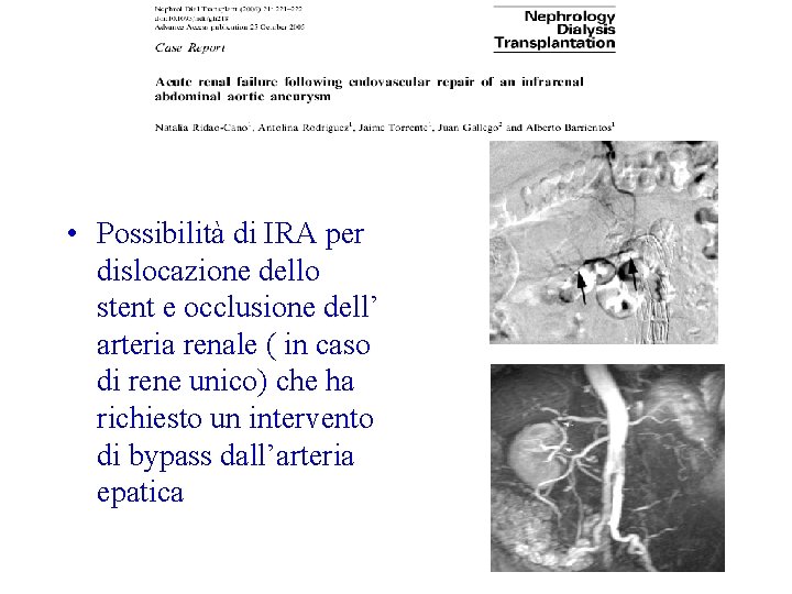  • Possibilità di IRA per dislocazione dello stent e occlusione dell’ arteria renale