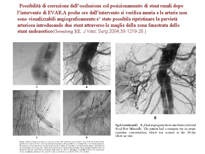 Possibilità di correzione dell’occlusione col posizionamento di stent renali dopo l’intervento di EVAR. A