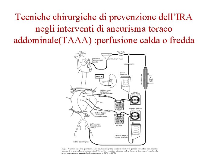 Tecniche chirurgiche di prevenzione dell’IRA negli interventi di aneurisma toraco addominale(TAAA) : perfusione calda