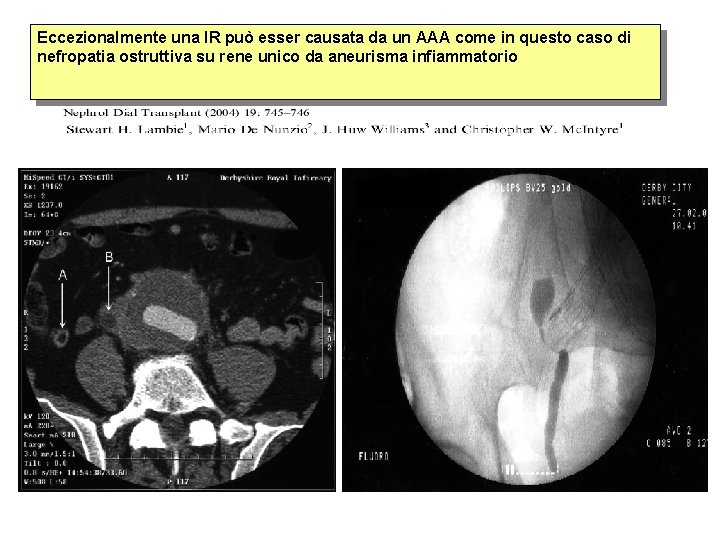 Eccezionalmente una IR può esser causata da un AAA come in questo caso di