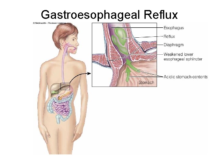 Gastroesophageal Reflux Gastroesophageal Reflux