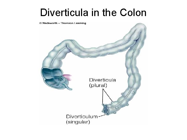 Diverticula in the Colon 