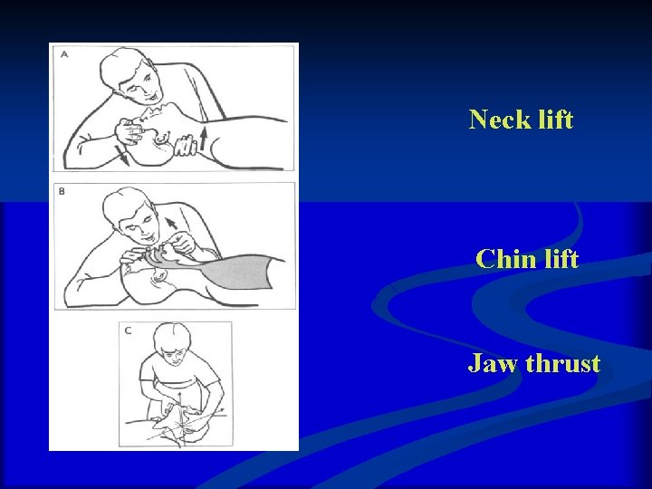 What are the indications of intubations n n