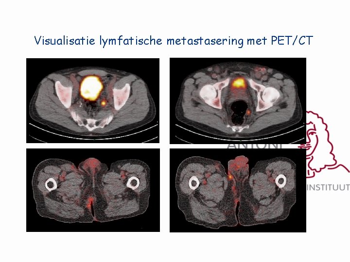 Visualisatie lymfatische metastasering met PET/CT 