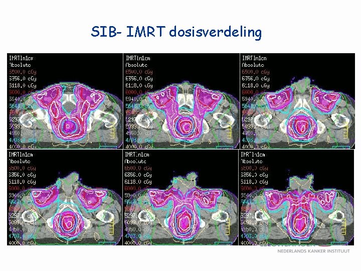SIB- IMRT dosisverdeling 