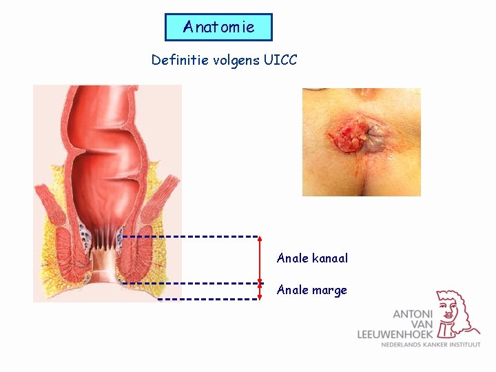 Anatomie Definitie volgens UICC Anale kanaal Anale marge 
