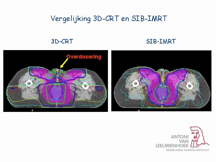 Vergelijking 3 D-CRT en SIB-IMRT 3 D-CRT Overdosering SIB-IMRT 