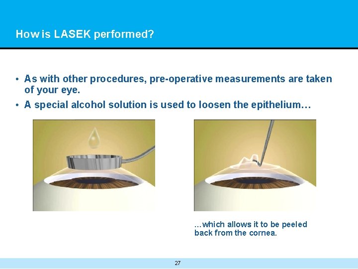 How is LASEK performed? • As with other procedures, pre-operative measurements are taken of
