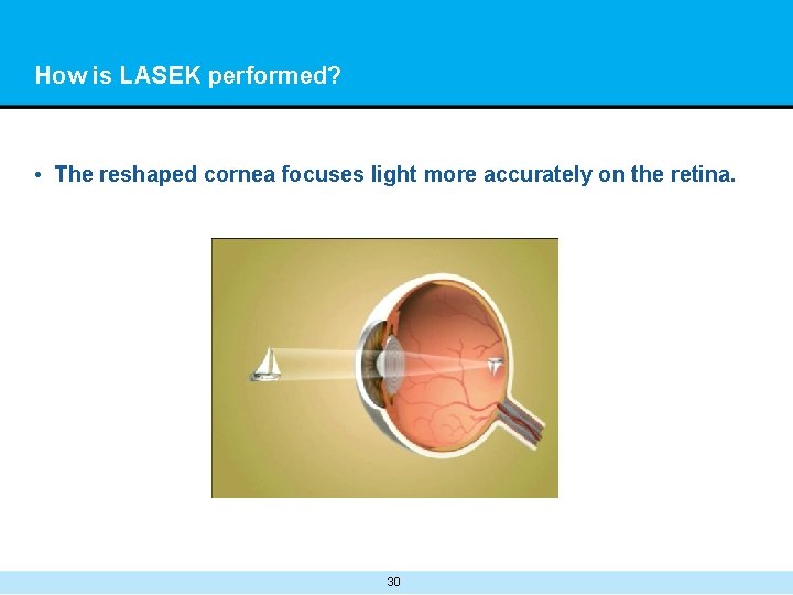 How is LASEK performed? • The reshaped cornea focuses light more accurately on the