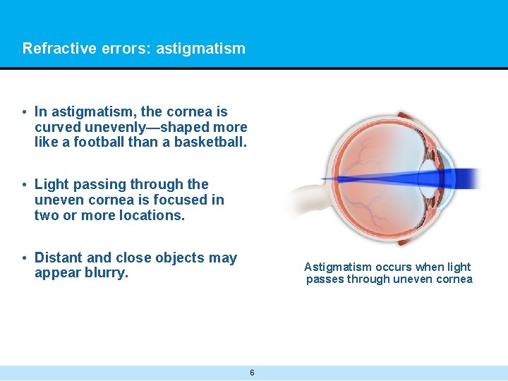 Refractive errors: astigmatism • In astigmatism, the cornea is curved unevenly—shaped more like a