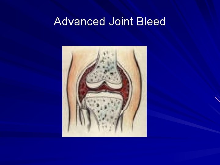 Advanced Joint Bleed 