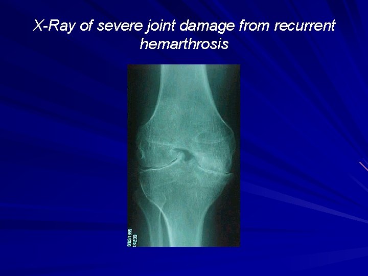 X-Ray of severe joint damage from recurrent hemarthrosis 