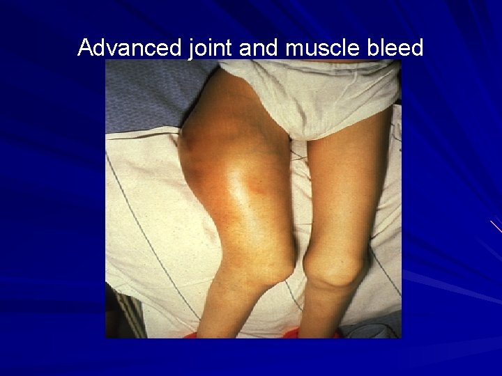 Advanced joint and muscle bleed 