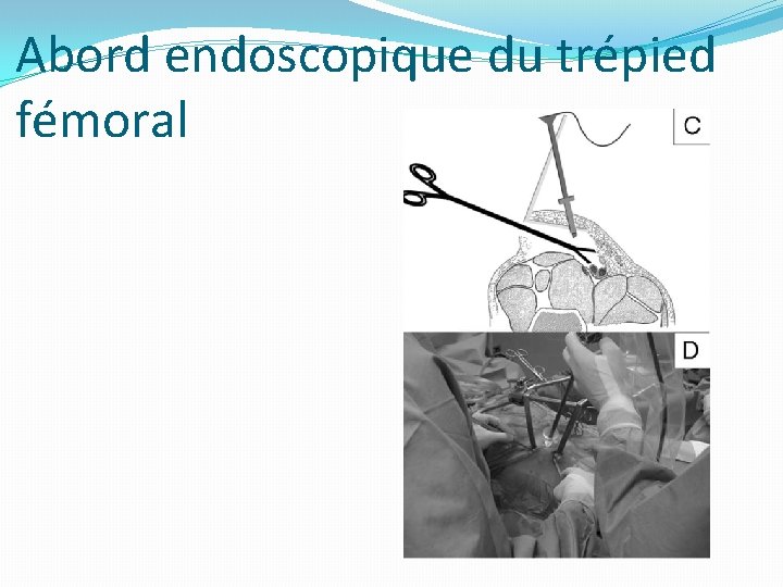 Abord endoscopique du trépied fémoral 