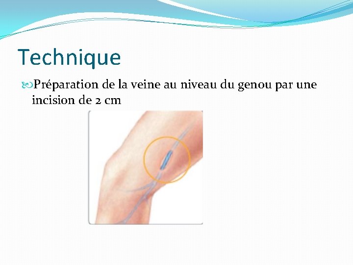 Technique Préparation de la veine au niveau du genou par une incision de 2