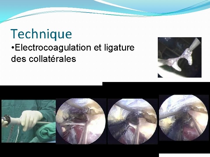 Technique • Electrocoagulation et ligature des collatérales 