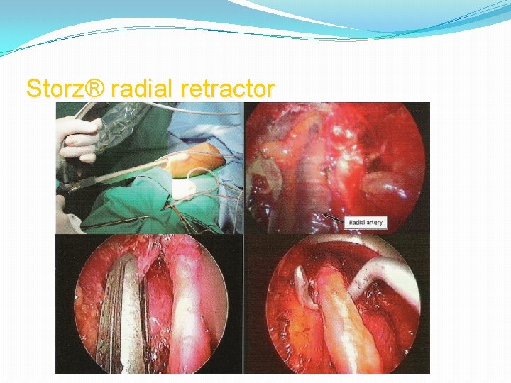 Storz® radial retractor 