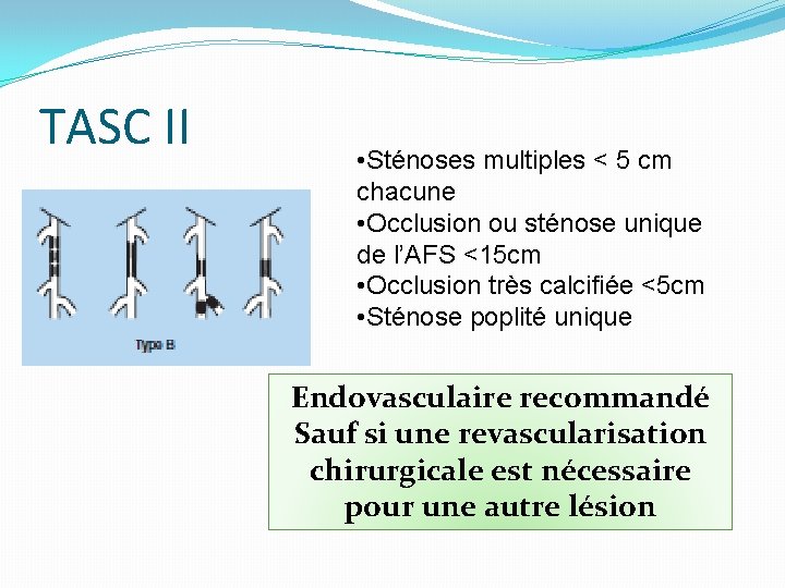 TASC II • Sténoses multiples < 5 cm chacune • Occlusion ou sténose unique