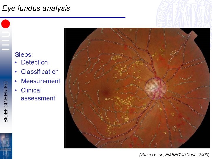 BIOENGINEERING Eye fundus analysis Steps: • Detection • Classification • Measurement • Clinical assessment