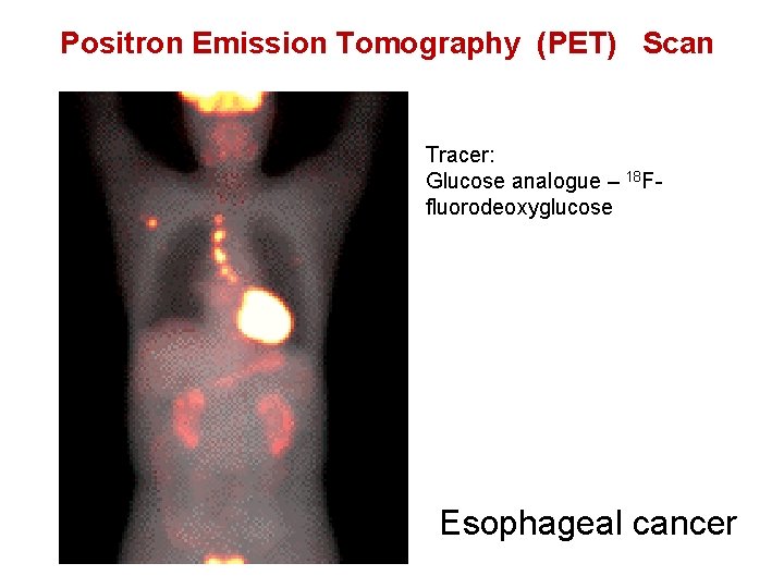 Positron Emission Tomography (PET) Scan Tracer: Glucose analogue – 18 Ffluorodeoxyglucose Esophageal cancer 