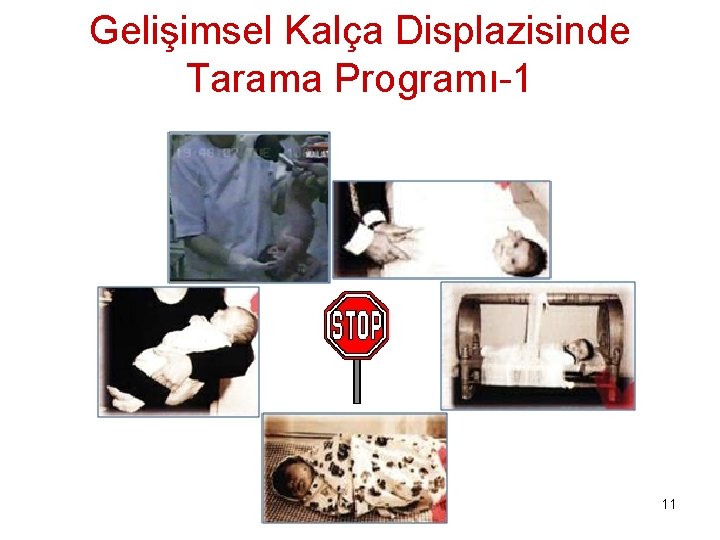 Gelişimsel Kalça Displazisinde Tarama Programı-1 11 