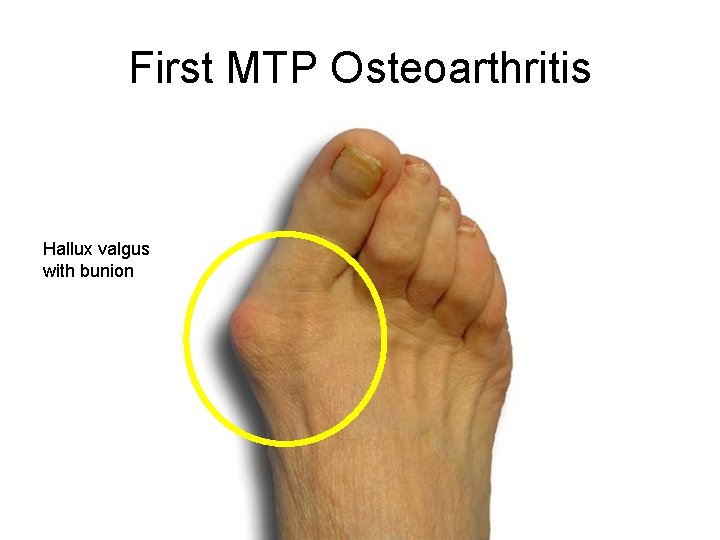 osteoarthritis first metatarsophalangeal joint