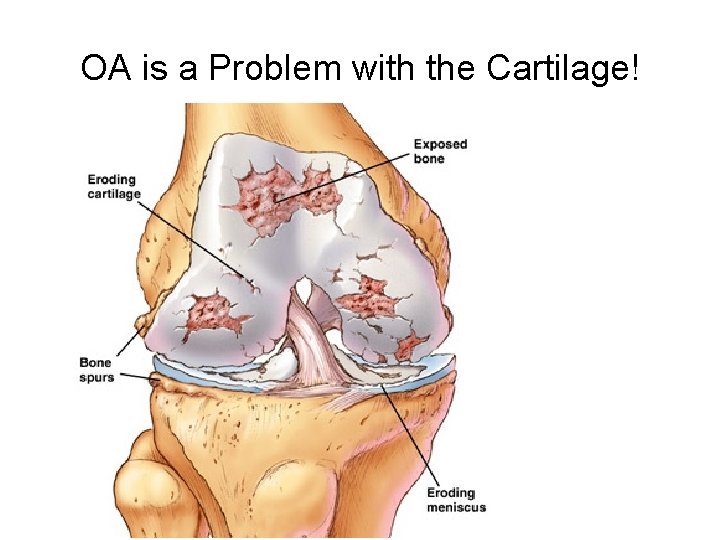 OA is a Problem with the Cartilage! 