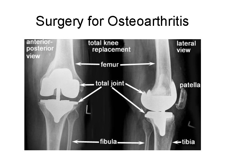 Surgery for Osteoarthritis 