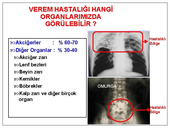 VEREM HASTALIĞI HANGİ ORGANLARIMIZDA GÖRÜLEBİLİR ? Akciğerler : % 60 -70 Diğer Organlar :