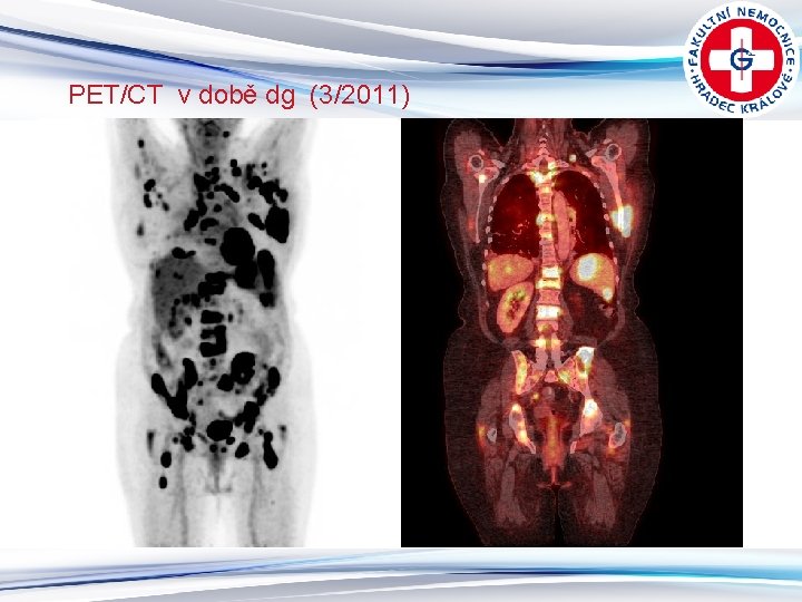 PET/CT v době dg (3/2011) 4 