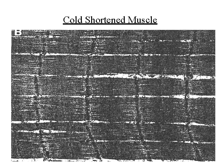 Cold Shortened Muscle 