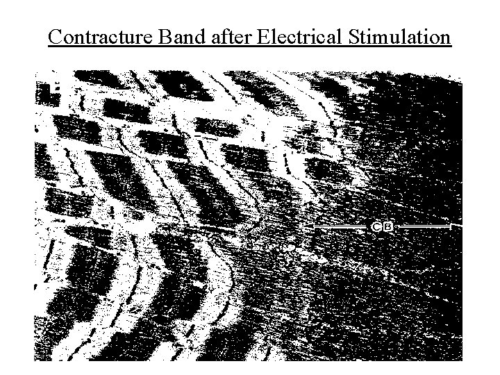 Contracture Band after Electrical Stimulation 