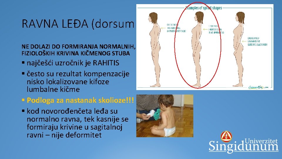 RAVNA LEĐA (dorsum planum)* NE DOLAZI DO FORMIRANJA NORMALNIH, FIZIOLOŠKIH KRIVINA KIČMENOG STUBA §