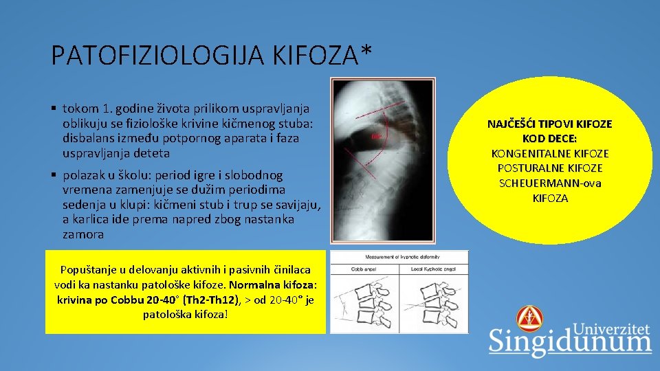 PATOFIZIOLOGIJA KIFOZA* § tokom 1. godine života prilikom uspravljanja oblikuju se fiziološke krivine kičmenog