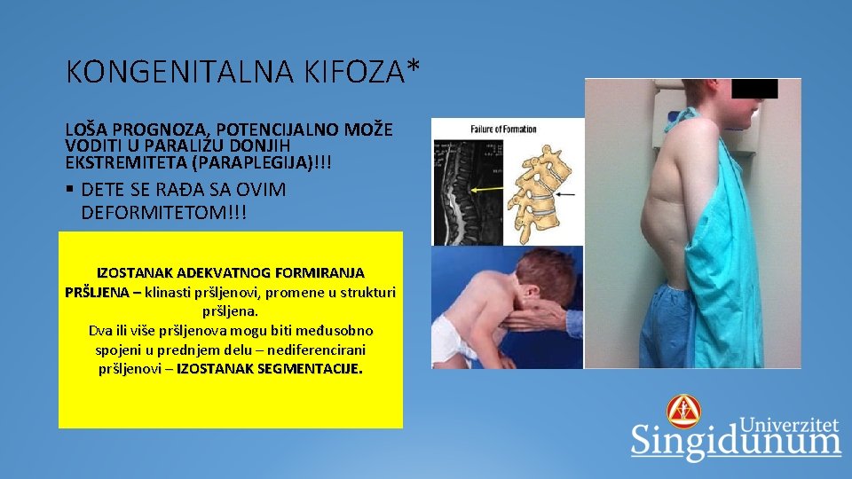 KONGENITALNA KIFOZA* LOŠA PROGNOZA, POTENCIJALNO MOŽE VODITI U PARALIZU DONJIH EKSTREMITETA (PARAPLEGIJA)!!! § DETE