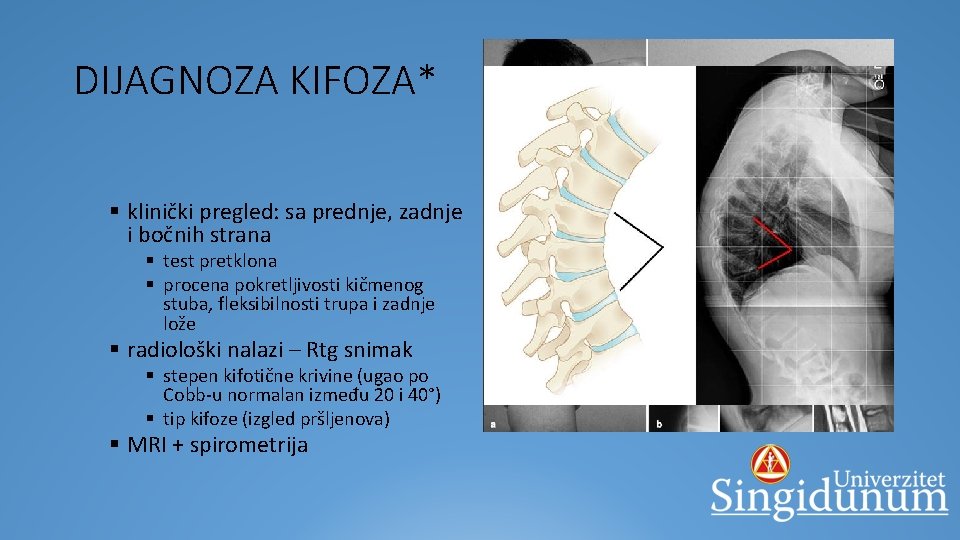 DIJAGNOZA KIFOZA* § klinički pregled: sa prednje, zadnje i bočnih strana § test pretklona