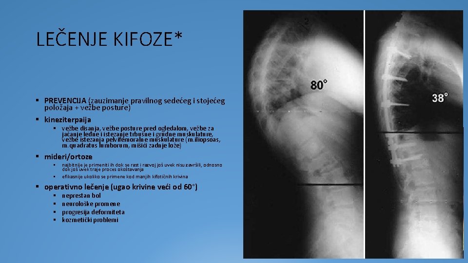 LEČENJE KIFOZE* § PREVENCIJA (zauzimanje pravilnog sedećeg i stojećeg položaja + vežbe posture) §