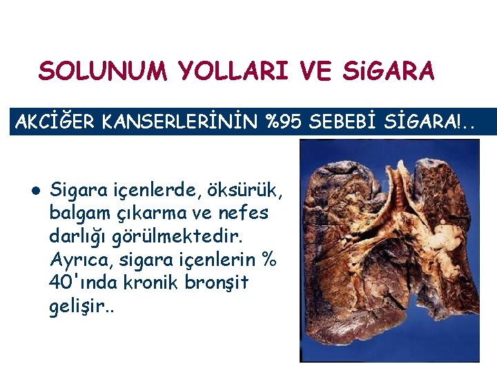 SOLUNUM YOLLARI VE Si. GARA AKCİĞER KANSERLERİNİN %95 SEBEBİ SİGARA!. . l Sigara içenlerde,