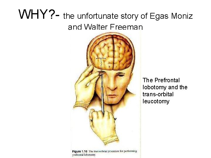 WHY? - the unfortunate story of Egas Moniz and Walter Freeman The Prefrontal lobotomy