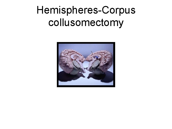 Hemispheres-Corpus collusomectomy 