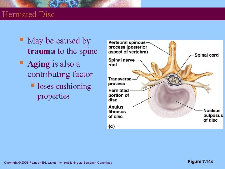 Herniated Disc § § May be caused by trauma to the spine Aging is