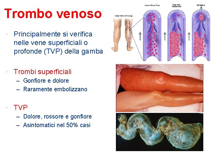 Trombo venoso • Principalmente si verifica nelle vene superficiali o profonde (TVP) della gamba