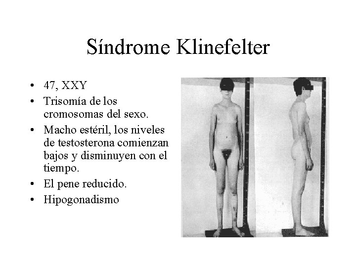 Síndrome Klinefelter • 47, XXY • Trisomía de los cromosomas del sexo. • Macho