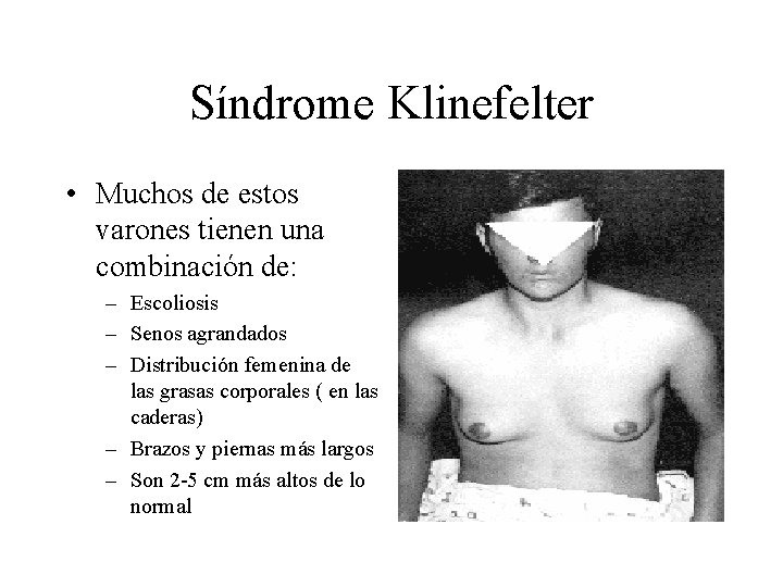 Síndrome Klinefelter • Muchos de estos varones tienen una combinación de: – Escoliosis –