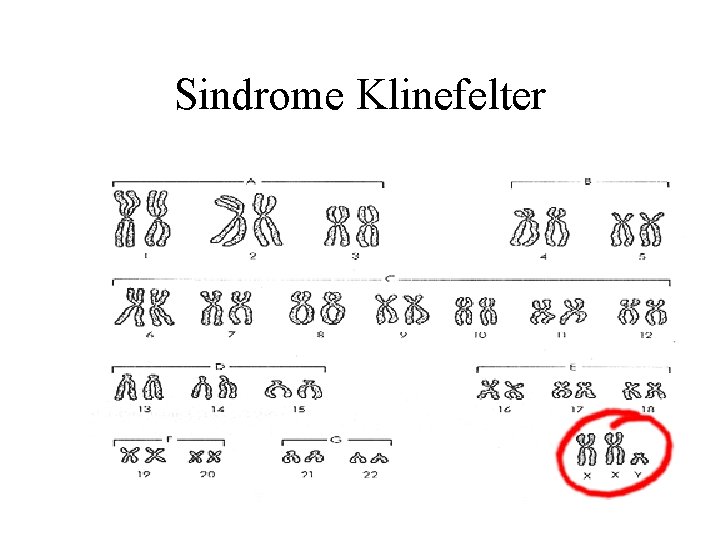Sindrome Klinefelter 