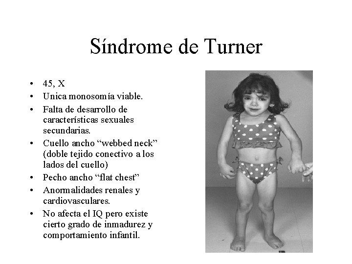 Síndrome de Turner • 45, X • Unica monosomía viable. • Falta de desarrollo