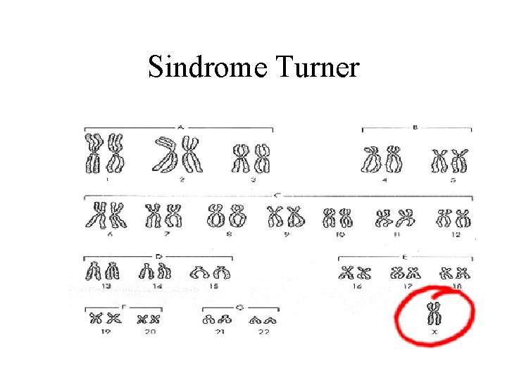 Sindrome Turner 