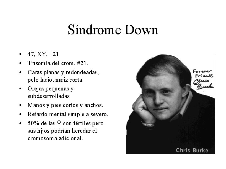 Síndrome Down • 47, XY, +21 • Trisomía del crom. #21. • Caras planas
