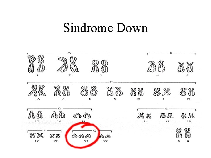 Sindrome Down 