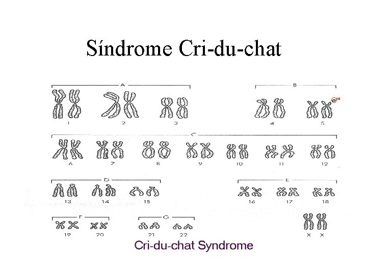 Síndrome Cri-du-chat 
